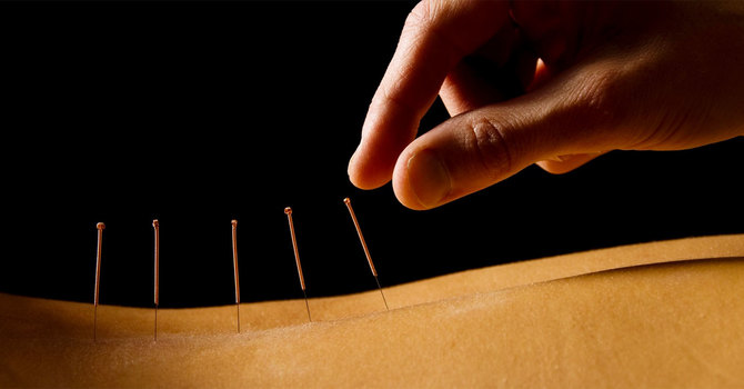 Dry Needling, what is it?