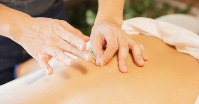 Dry Needling vs Acupuncture: What I Use in My Clinic